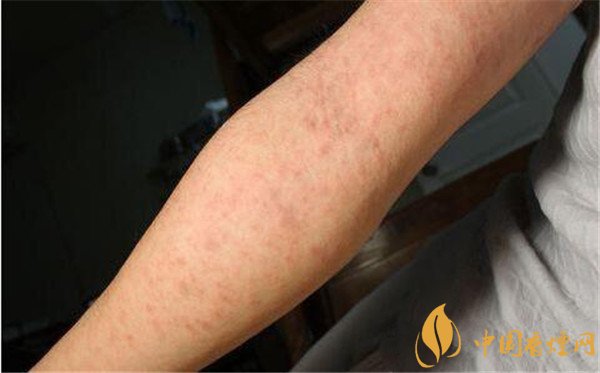 戒煙藥暢沛副作用有哪些   戒煙藥暢沛對人體的危害（有自殺風(fēng)險）